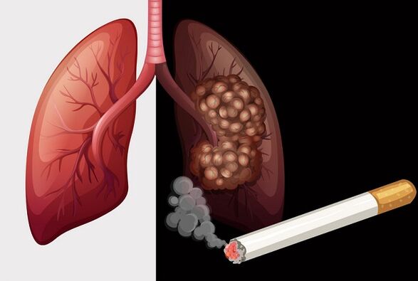 Pulmóns do fumador e pulmóns sans
