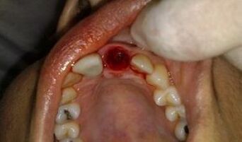 a localización do dente extraído